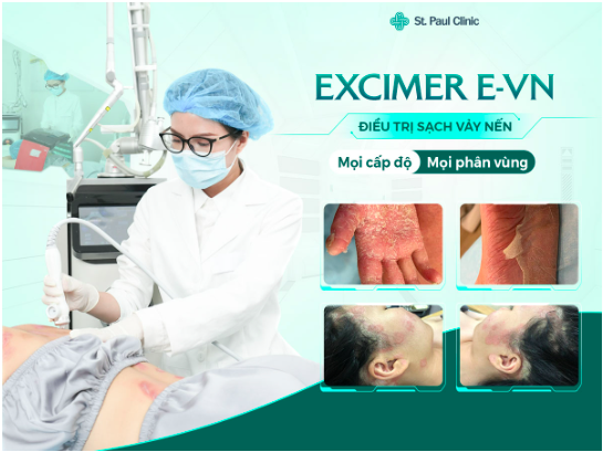 Thực hư liệu trình điều trị vẩy nến bằng công nghệ cao Eximer E - VN tại St.Paul Clinic?